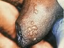 herpes genitalis pada penis