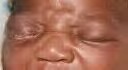 gonorrhea menginfeksi mata bayi yang tertular dari ibunya.