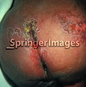 Infeksi neonatal herpes simplex