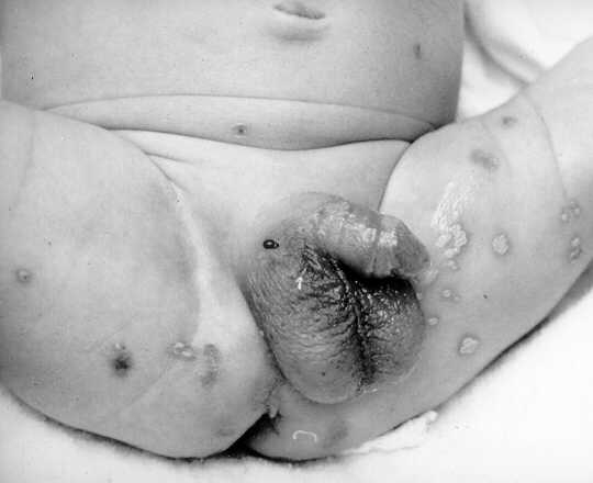 Infeksi neonatal herpes simplex